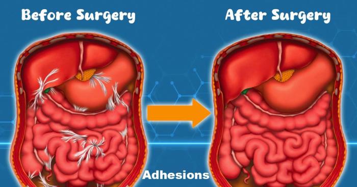 Abdominal lysis of adhesions cpt code