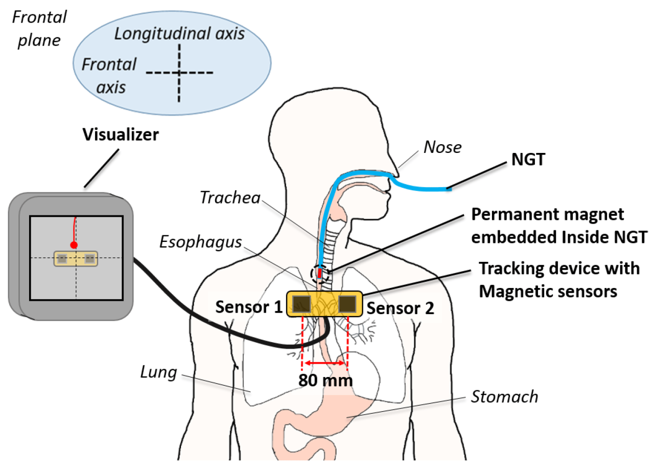 A nurse is checking the client's nasogastric tube for placement